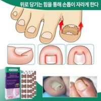 DRYMARTINE 내성발톱교정테이프 발톱 테이프 200pcs, 200개